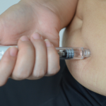 Emagrecimento com medicamentos e cirurgia plástica: por que médicos reforçam a importância do tempo de recuperação antes do procedimento